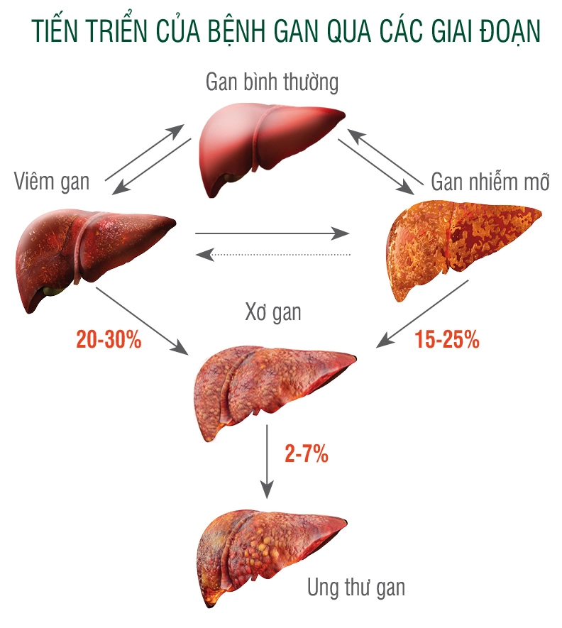 các giai đoạn gan nhiễm mỡ