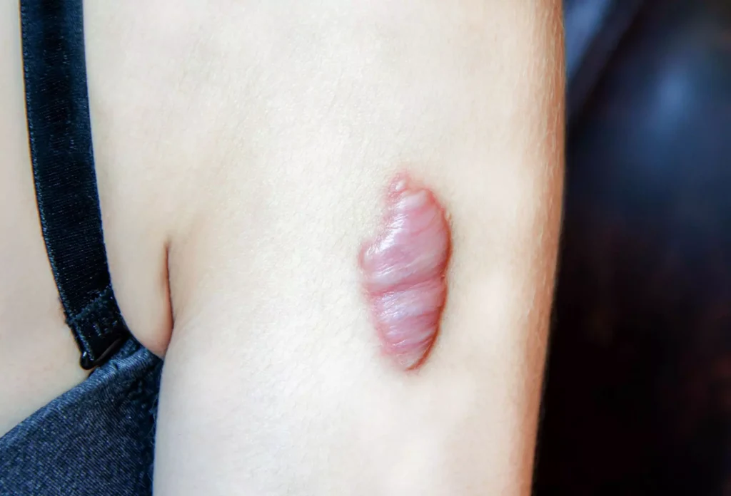 Phân Loại Các Loại Sẹo Mổ & Khả Năng Xét Duyệt Hồ Sơ