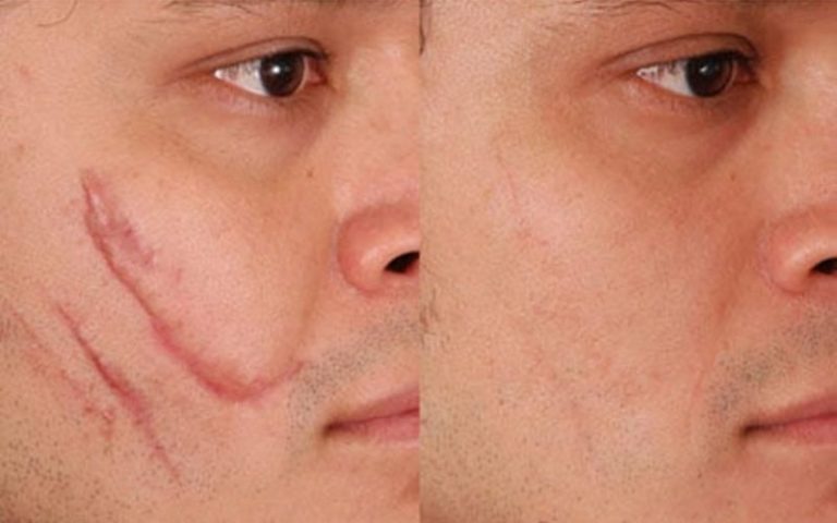 Sẹo Mổ Cũ Có Ảnh Hưởng Kết Quả Khám Sức Khỏe Đi Nhật Không?