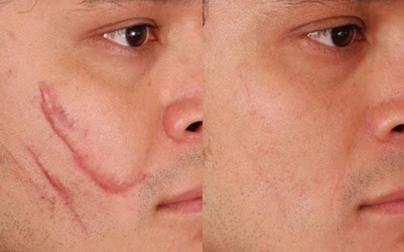 Sẹo Mổ Cũ Trước Khi Chọn Chương Trình