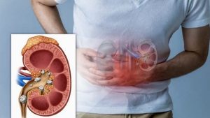 Người bị sỏi thận có đủ điều kiện đi xuất khẩu lao động Nhật Bản không? Tìm hiểu quy định y tế chính thức và kinh nghiệm thực tế từ Hải Phong Connect.